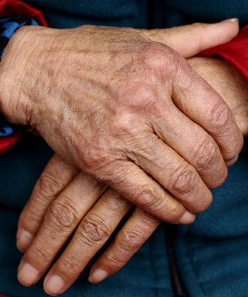 Če imate po 50. letu zjutraj otečene prste, to ni vedno “samo starost”